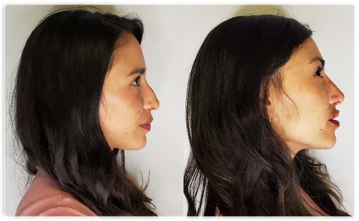 Non Surgical Facelift 1